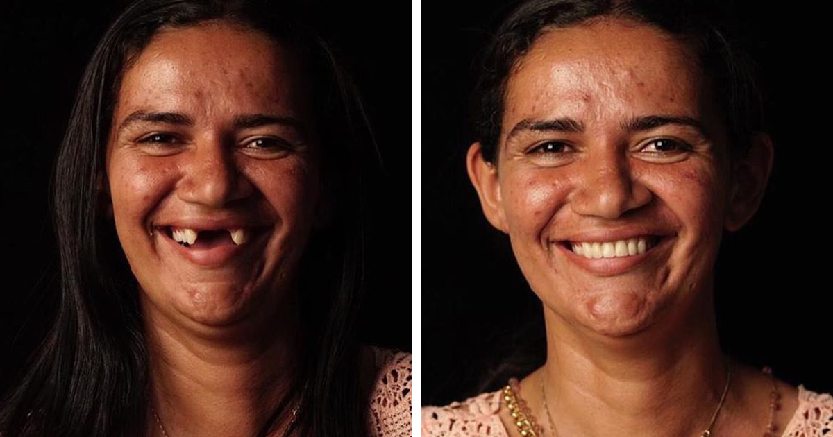 34 Antes E Depois De Pessoas Que Tiveram Seus Dentes Consertados Por Este Dentista Que Viaja Oferecendo Seus Serviços Para Quem Precisa